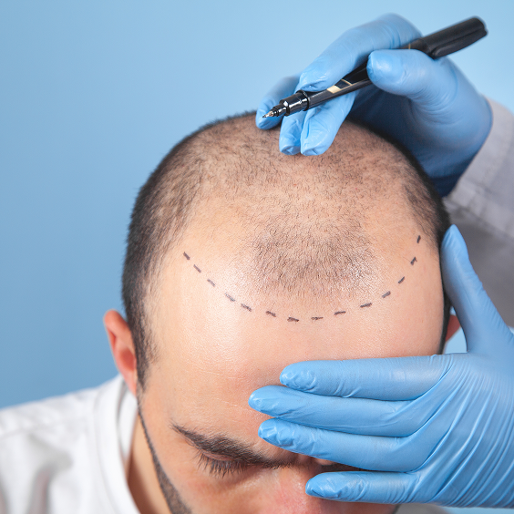 Hair Transplantation Services